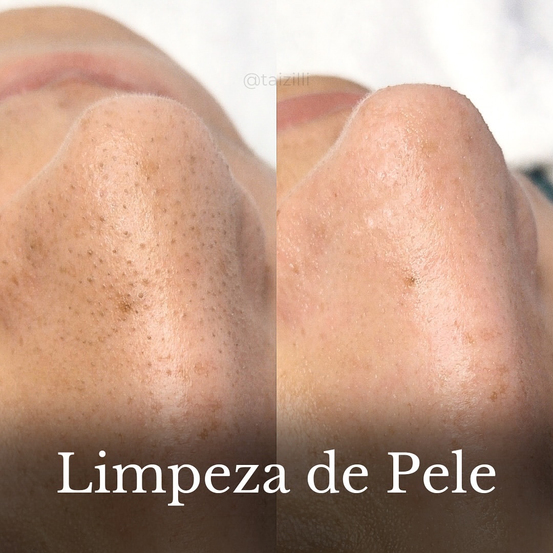 Resultado limpeza de pele 4